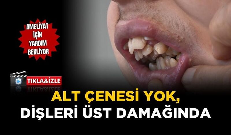 ALT ÇENESİ YOK, DİŞLERİ ÜST DAMAĞINDA