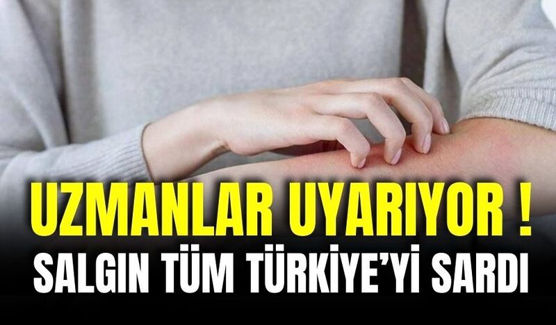 UZMANLAR UYARIYOR!  UYUZ TÜM TÜRKİYE’Yİ SARDI