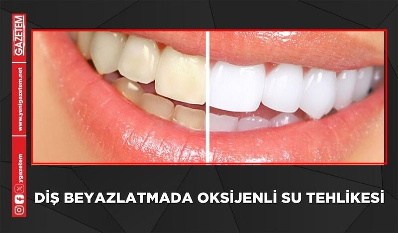 DİŞ BEYAZLATMADA OKSİJENLİ SU TEHLİKESİ