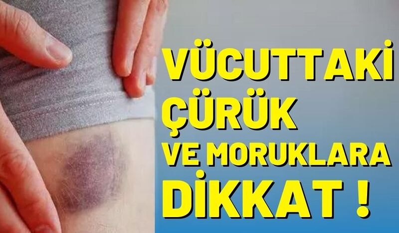 VÜCUTTAKİ ÇÜRÜK VE MORUKLARA DİKKAT !