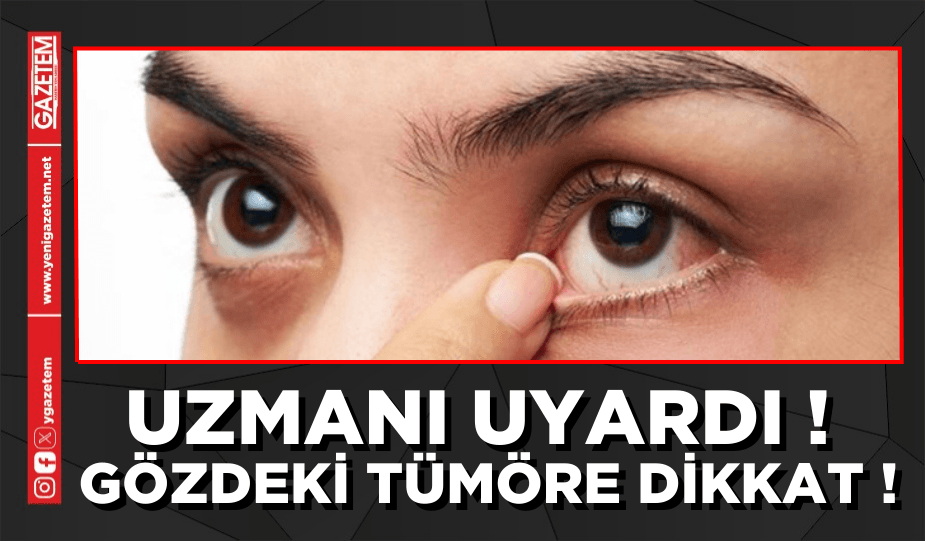 UZMANI UYARDI! GÖZDEKİ TÜMÖRE DİKKAT!