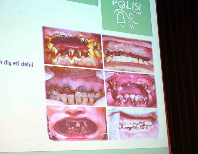 Metamfetamin kullanan bağımlıların ağız ve dişleri görenleri korkuttu